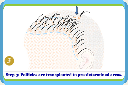 Follicular Unit Extraction Step 3 in China